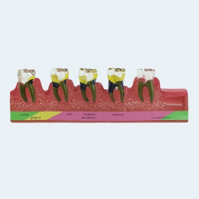 Dental Standard Decay Tooth Model Manual Power Source for Oral Therapy Equipment Denture Disease Teaching Accessory Teeth Model