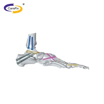 Orthopedic Trauma Cannulated Special Herbert Screw Orthopedic Screws Nails Orthopedic