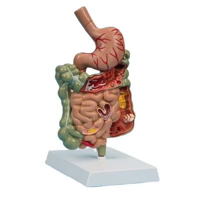GI TRACT Model Diseased Digestive System Stomach Anatomy Small and Large Intestine Colon Anatomical Model Educational Tool