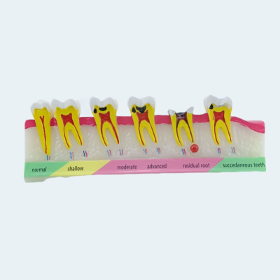 Dental Pathology Model for Training Detachable Plastic Decay Anatomy of Teeth Educational Equipment for Oral Therapy