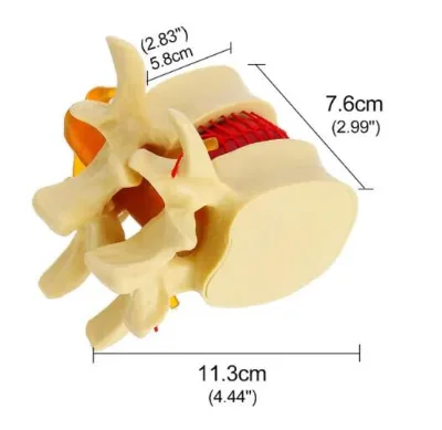 Lumbar Spine Model Intervertebral Disc Model Diseased Lumbar Spine Model