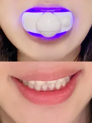 VERY STRONG FAST TEETH TOOTH WHITENING KIT, Including Mouth Trays