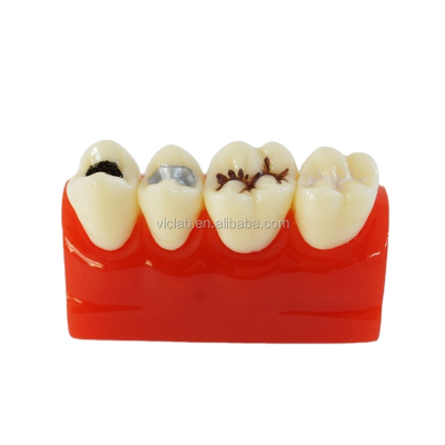 Caries Sealantant Demonstration Decayed Tooth Model With Good Quality