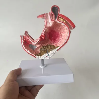 Medical Science Large Stomach Disease Model Stomach Pathology Anatomical Model