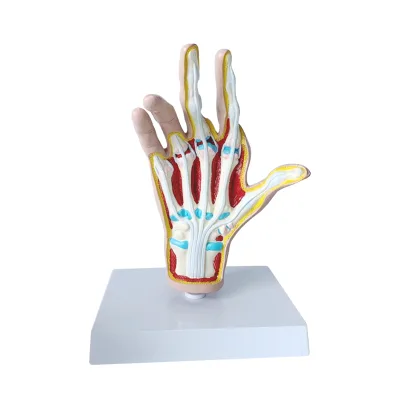 Hand Model of Human Pathological Changes, Rheumatic Palm Anatomy, Hand Palmar Tendon Pain, Rheumatoid Joint Teaching Tool SMM054
