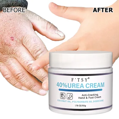 Best Seller OEM Tea Tree 40% Urea Foot Cream 150 Grams Anti Cracked Heel Urea Foot Cream Lotion for Men and Women