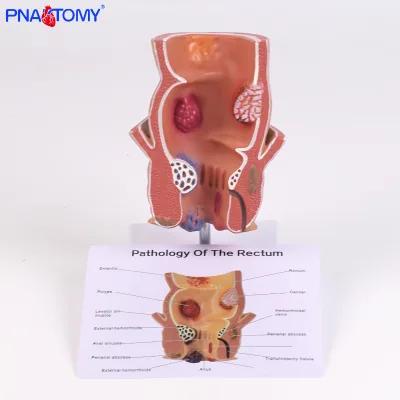 PNATOMY Rectum and Anal Model Pathological Model of the Rectum Model Human Anatomical Model Medical Gift Teaching Tool