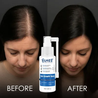 Custom Label Anti Hair Loss Treatment Spray Regrowth Nutrient Solution Repair Serum Hair Growth Spray Men for Women