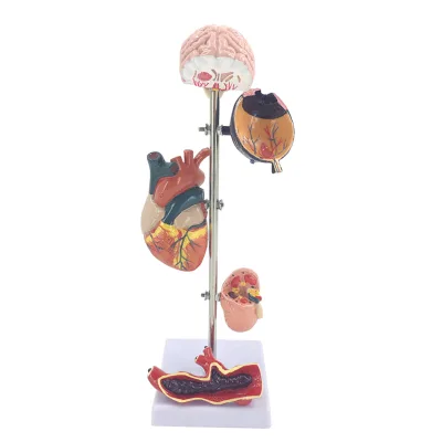 5-Part Anatomical PVC Model of Hypertension Demonstrating Pathological Changes in Brain Eye Heart Kidney Vascular Viscera