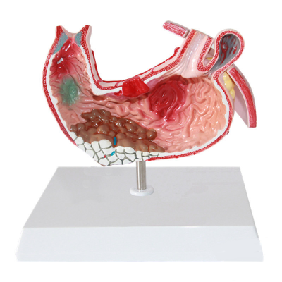 Human Stomach Pathological Section Anatomical Model for Medical School