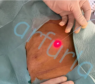 Laser Fiber for Facelifting for 980nm 1470nm Laser Machine Use Fiber Cutting Soft Tissue 400um/600um