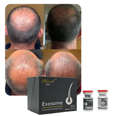 Exosoom Blemish Spot Clearing Acne Treatment Cream Gentle Pores Minimizing Skincare Facial Product Scalp Serum