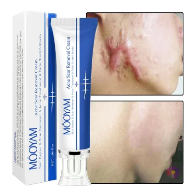 Effective Scar Removal Face Cream Acne Pimples Stretch Marks Remove Gel Smoothing Firming Anti Stretch Marks Scar Repair Cream
