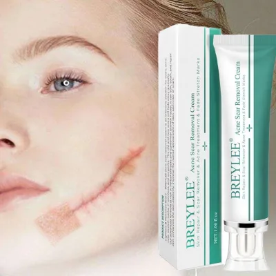 OEM/ODM Cream for Acne Scar Gentle Anti Acne Stretch Mark Removal Ointment Stretch Marks Removing Scar Removal
