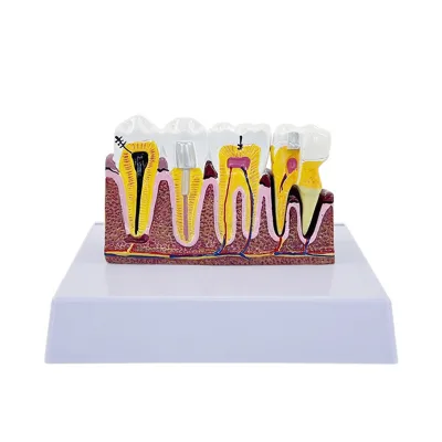 Dental Oral Caries Decomposition Model Demonstration of Dental Caries Development Pathology Doctor-patient Communication