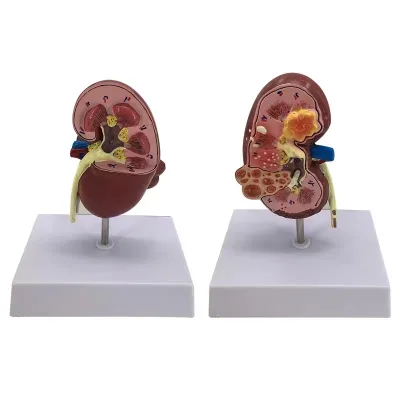 Pathological and Healthy Kidney Anatomical Model for Medical Science