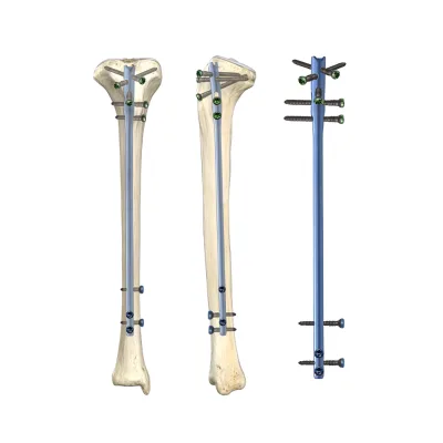 Tibial Nail Titanium Hot-selling Easy to Insert Prevent Soft Tissue Injury Increase Stability Anatomical Shape Hollow Design