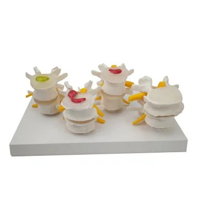 Medical Science 4 Stage Pathological Human Lumbar Vertebrae Spine Herniated Disc Model