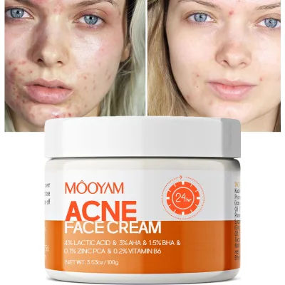 Wholesale Custom Facial Scar Repair Cream Facial Dark Spot Anti Acne Removal Acne Lightening Scar Removing Face Cream