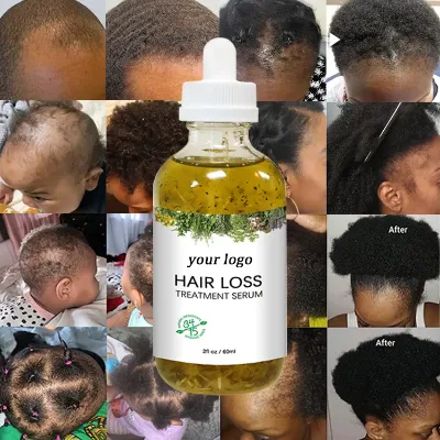Top Selling Herbal Anti Hair Loss Serum Fall Ginger Extra Strength Hair Growth Oil Damaged Hair Includes Dropshipping