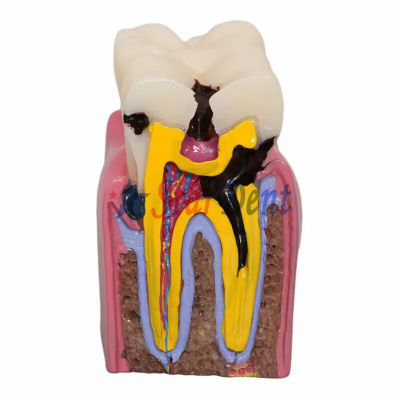 Tooth Decay Model Dental Teeth Model Decayed Tooth Practise Model