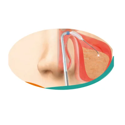 Sinus Surgical Instruments Sinus Balloon Dilation Catheter