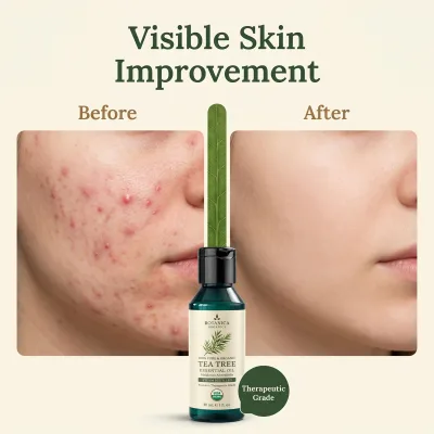 Wholesale Moisturizing Organic Natural Acne Serum Vitamin E Pure Tea Tree Essential Oil Face
