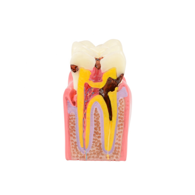 Dental Teeth Model Dental Caries Tooth Model for Patient Education and Explanation