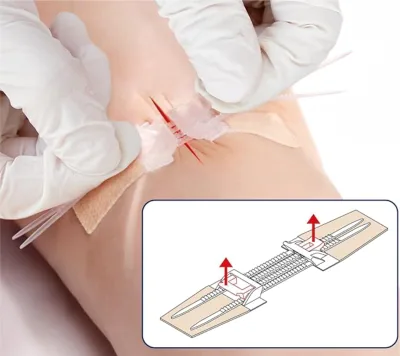 Emergency Wound Closure Strips Wound Closure Device Suture-Free Skin Closure for Home First Aid Kits