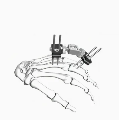 Orthopedic External Fixator Joint Fixator Rail Finger External Fixation