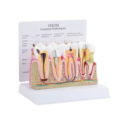 CBM-002E Education Medical Anatomical Model Human Teeth Common Pathologies Model