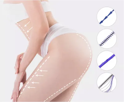 Effective Absorbable Sharp Needle Polydioxanone Suture 26g 60mm Tornado Screw Pdo Thread
