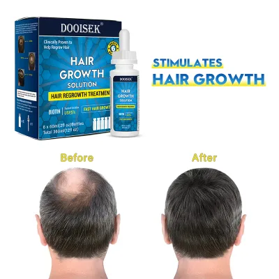 Treatment for Hair Loss Topical Solution Scalp Circulation Hair Regrowth Hair Growth Serum
