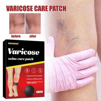 MIAOSANSHU OEM/ODM Varicose Veins Patch - Natural Circulation Boost & Discomfort Relief