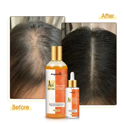 Rogaine Hair Loss Regrowth Scalp Care Anti LOSS Hair Growth Serum Angelica Sinensis Hair Treatment
