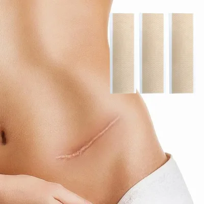 Skin Friendly Medical Grade Scar Patch for Removing Scar Reusable Water-Resistant Silicone Scar Patch for Post-Surgery