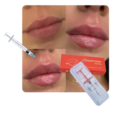 1ml 2ml Wholesale New Hyaluronic Acid Cosmetic Plastic Surgery Super Lip Filler for Lip Enlargement Injection OEM&ODM