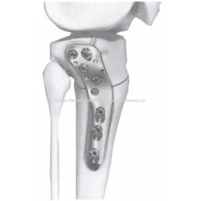 Proximal Lateral Tibial Osteotomy Locking Bone Plate