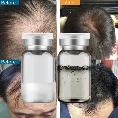 Anti Hair Regrowth Men's Hair Beard Growth Derma Microderma Effective Hair Regrowth Tonics