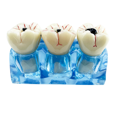 Multi-purpose Oral Hygiene Teaching Tool Dental Decayed Teeth Model for Denture Caries Disease Oral Care Decay Caries Process