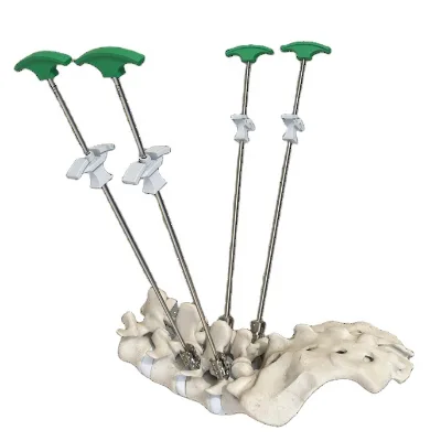 Bone Cement Screws PMMA Spine Implant System Orthopedic Spinal Surgery Hospital Use Titanium Alloy Screws