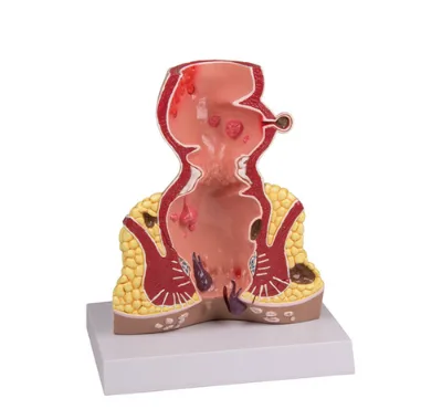 BMN/D015B Medical Science Model Vivid Rectal Lesion Manikin for School Teaching Rectal Pathology Model