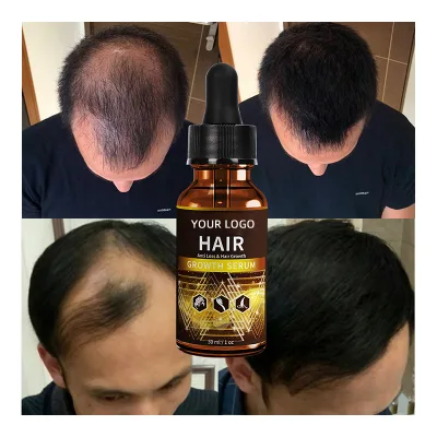 Organic Natural Santymo Coconut Herbal Supplements Scalp Essential Oil Biotin Olive Kids Wholesale Gallon Alopecia Hair Hair