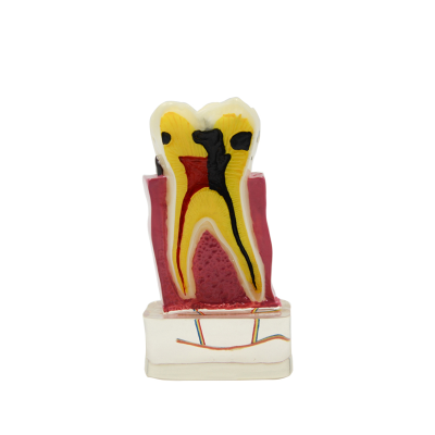 Acrylic Display model Decayed Tooth Artificial Dental Teeth Model