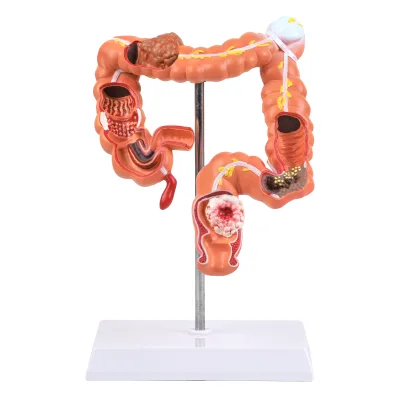 Silicone Colon Pathology Model for Training Demonstrating Regional Pathologies & Colorectal Cancerous Changes for Schools