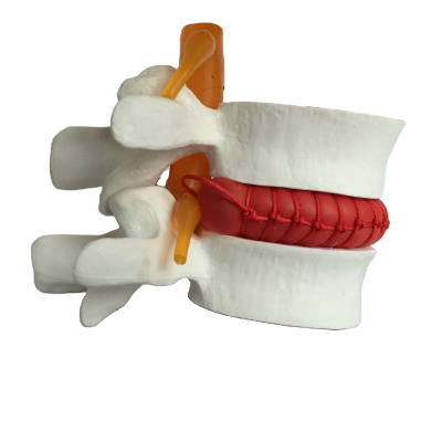 Lumbar Vertebrae With Prolapse 2 Times Enlarged Anatomical Model