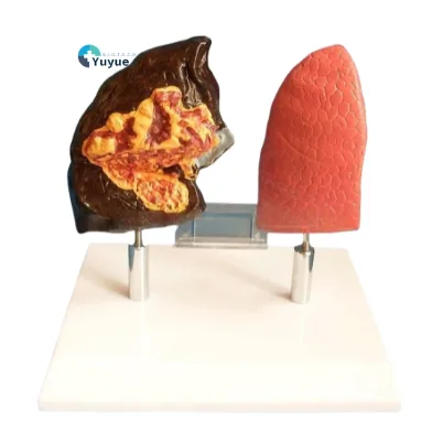 Medical School Education PVC Lung Anatomy Model Features Smoking Effects on Pathological Respiratory Structure