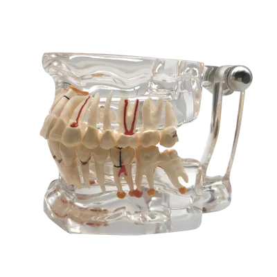 32 Tooth Full Mouth Transparent Impant Disease Teeth Model Dentist Standard Pathologic