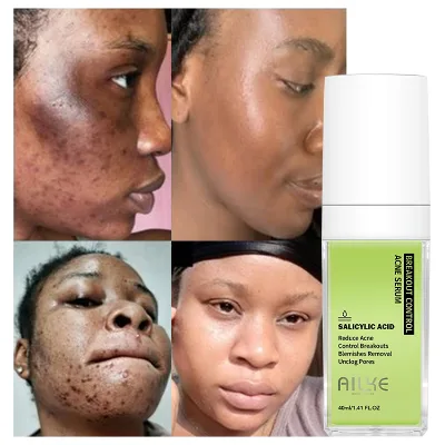 OEM Wholesale Organic Whitening Anti-Aging Salicylic Acid Glycolic Acid Aloe Vera for Oil Control Acne Facial Serum
