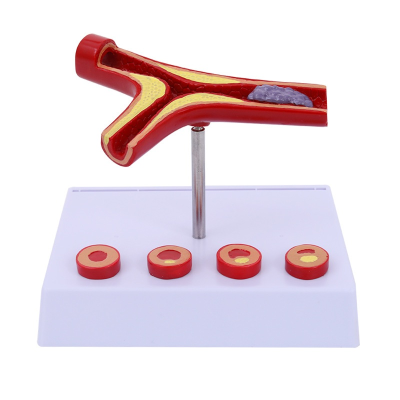 Coronary Artery Cardiovascular Model for Elderly Thrombosis Heart Model for Nurse Training Medical Science Hardening Model
